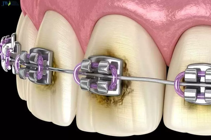 7 Cách vệ sinh răng miệng khi niềng có thể bạn chưa biết! 1