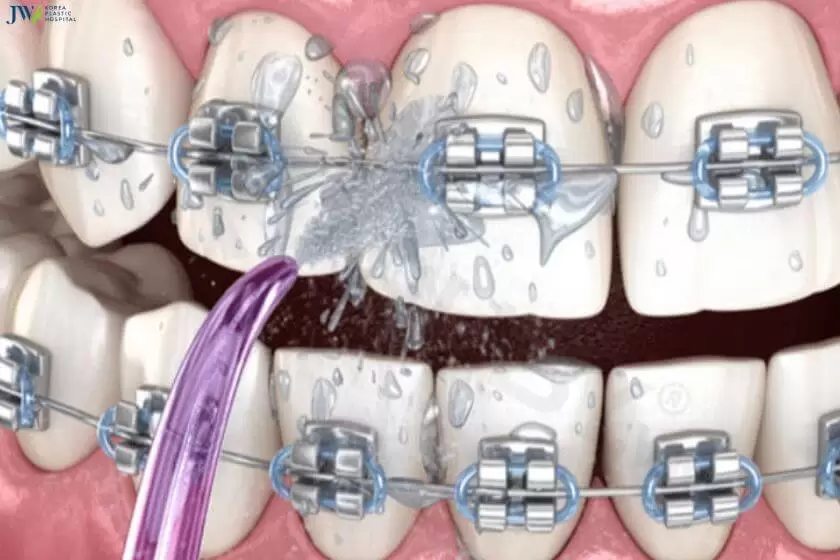 7 Cách vệ sinh răng miệng khi niềng có thể bạn chưa biết! 3