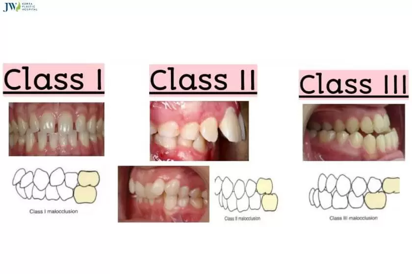 Các dạng khớp cắn