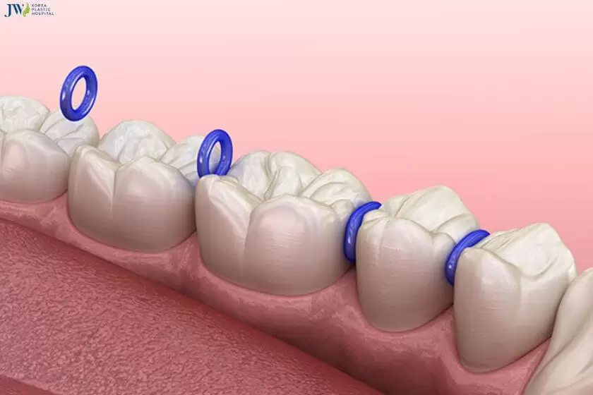 Các loại thun niềng răng phổ biến và tính năng của chúng 4