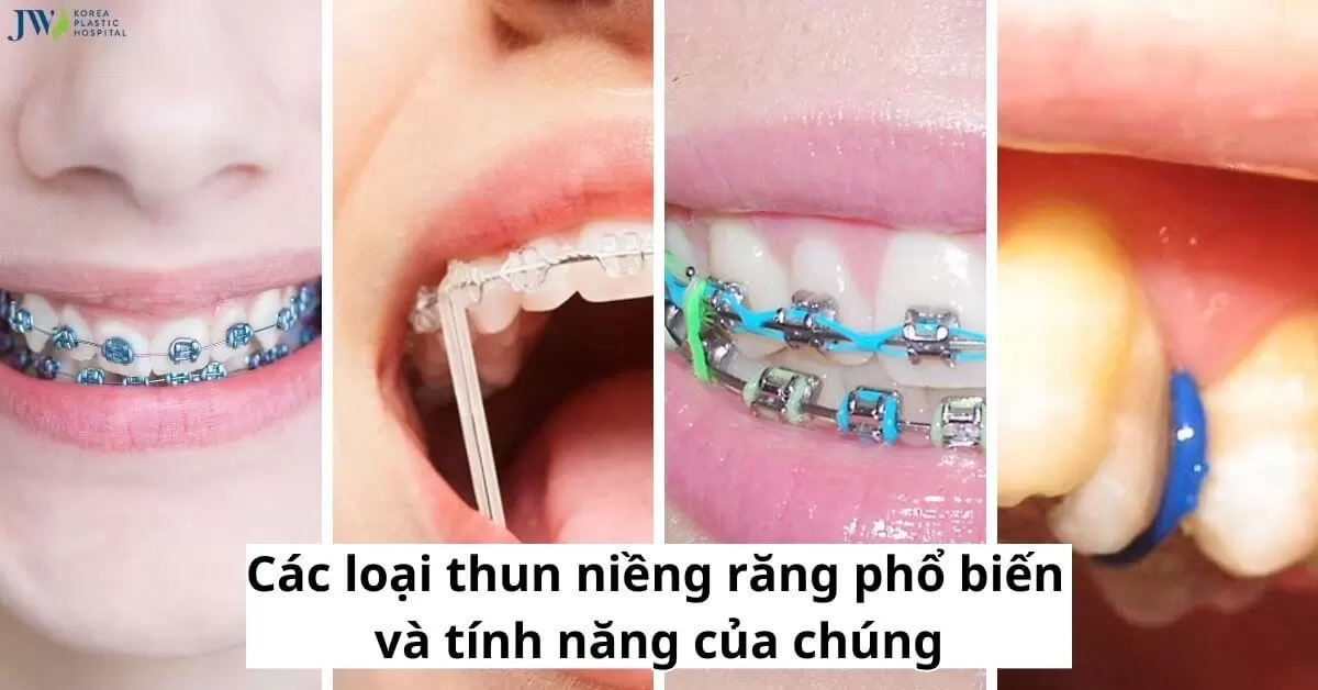 Các loại thun niềng răng phổ biến và tính năng của chúng