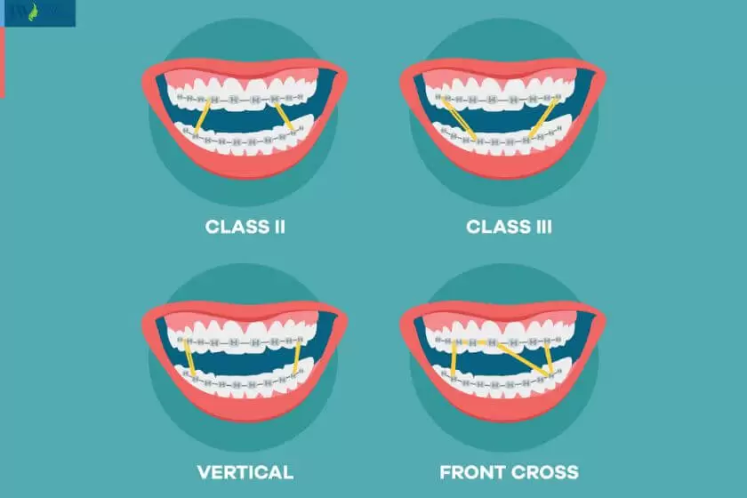Các trường hợp sử dụng thun liên hàm