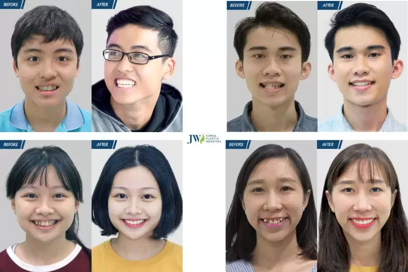 Kết quả điều trị niềng răng tại bệnh viện JW