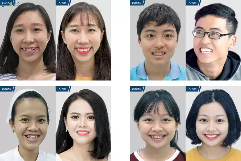 Kết quả điều trị niềng răng tại bệnh viện JW