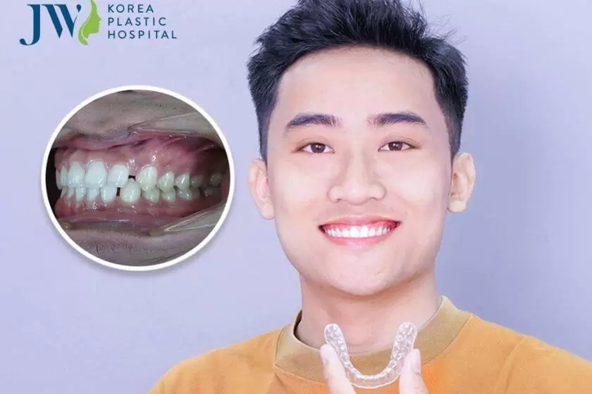 Kết quả niềng răng AI