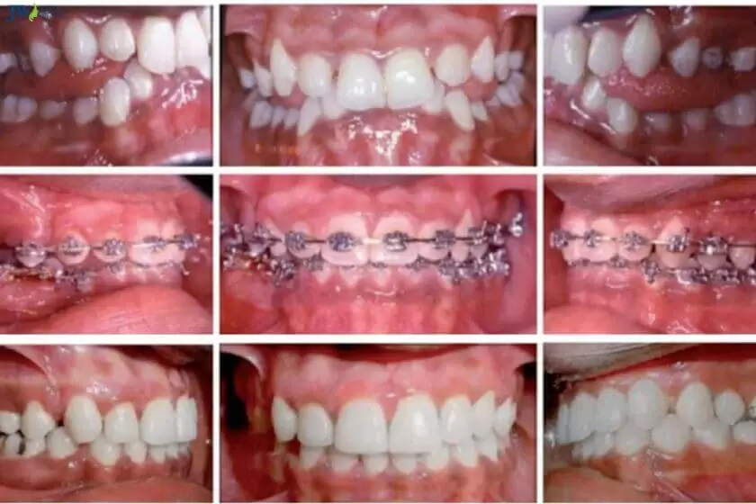 Khắc phục lệch khớp cắn bằng niềng răng