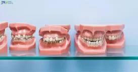 Lệch khớp cắn là gì? Niềng răng có trị lệch khớp cắn được không? thumb