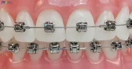 Những điều cần biết về niềng răng mắc cài tự buộc!