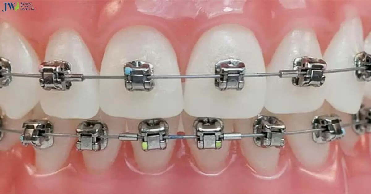 Những điều cần biết về niềng răng mắc cài tự buộc!