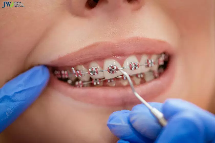 Niềng răng có gây ê buốt răng không? 1