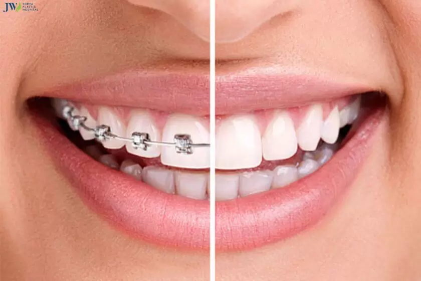 Niềng răng có làm mũi cao hơn không? 2
