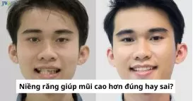 Niềng răng có làm mũi cao hơn không? thumb