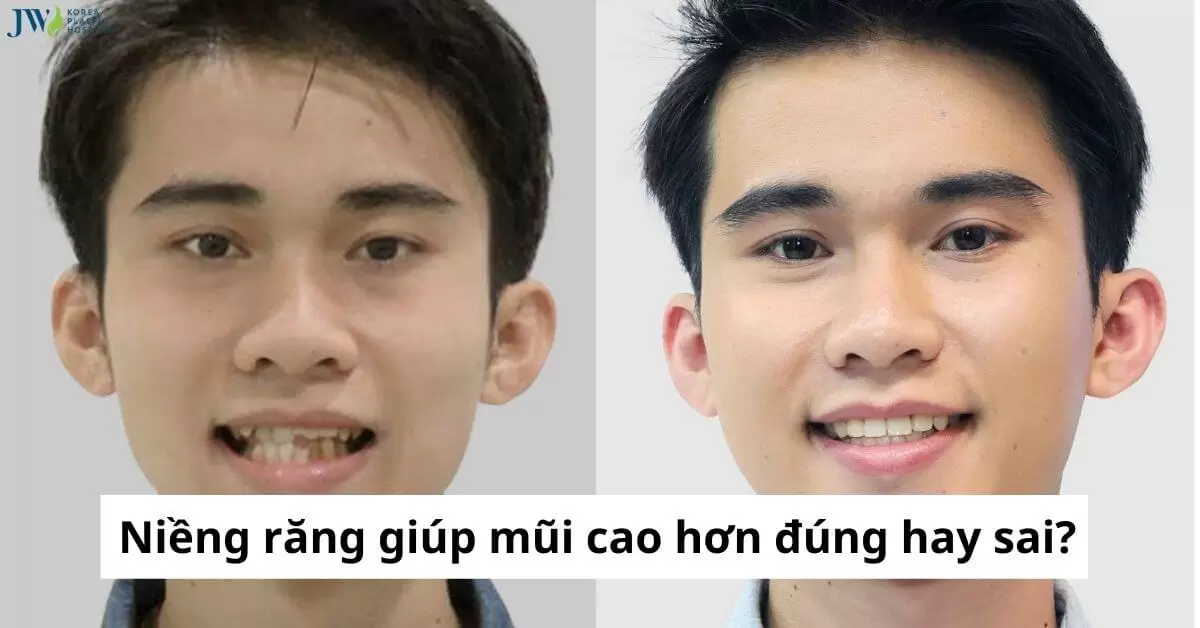 Niềng răng có làm mũi cao hơn không?