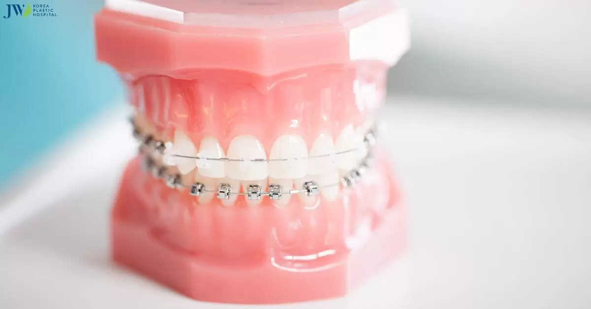 Niềng răng không cần phẫu thuật: Đúng hay sai?