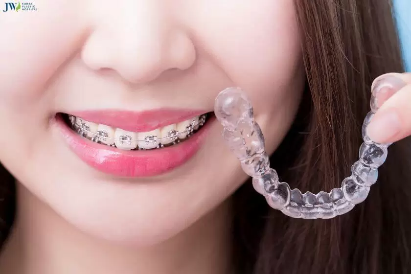 Niềng răng mắc cài và trong suốt