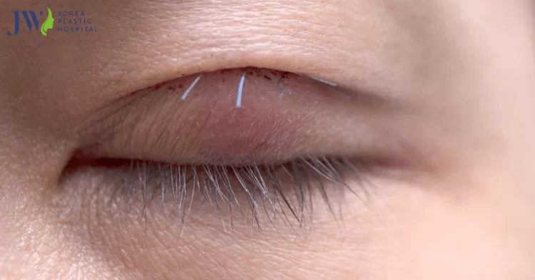 Cắt mắt hai mí và 5 điều bạn có thể chưa biết