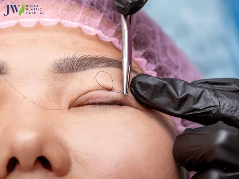 Cắt mắt hai mí và 5 điều bạn có thể chưa biết