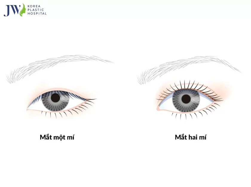 Cắt mắt hai mí và 5 điều bạn có thể chưa biết