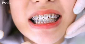 dấu hiệu khi mới niềng răng