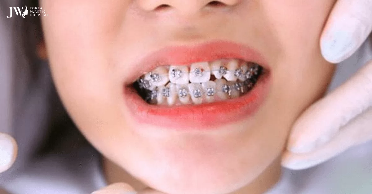8 dấu hiệu khi mới niềng răng
