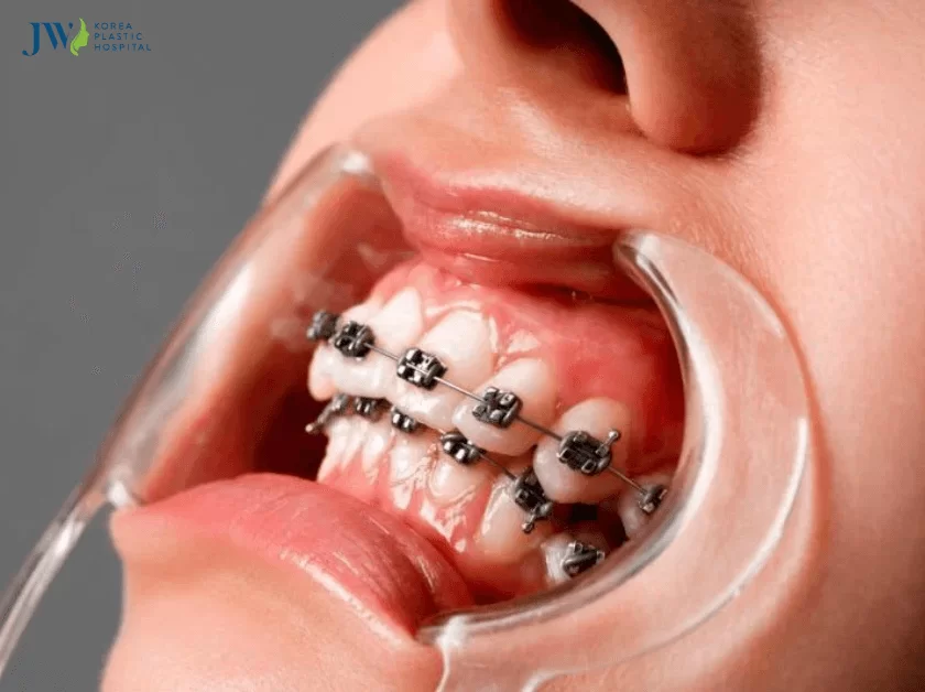 dấu hiệu khi mới niềng răng