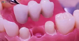 làm cầu răng sứ niềng răng