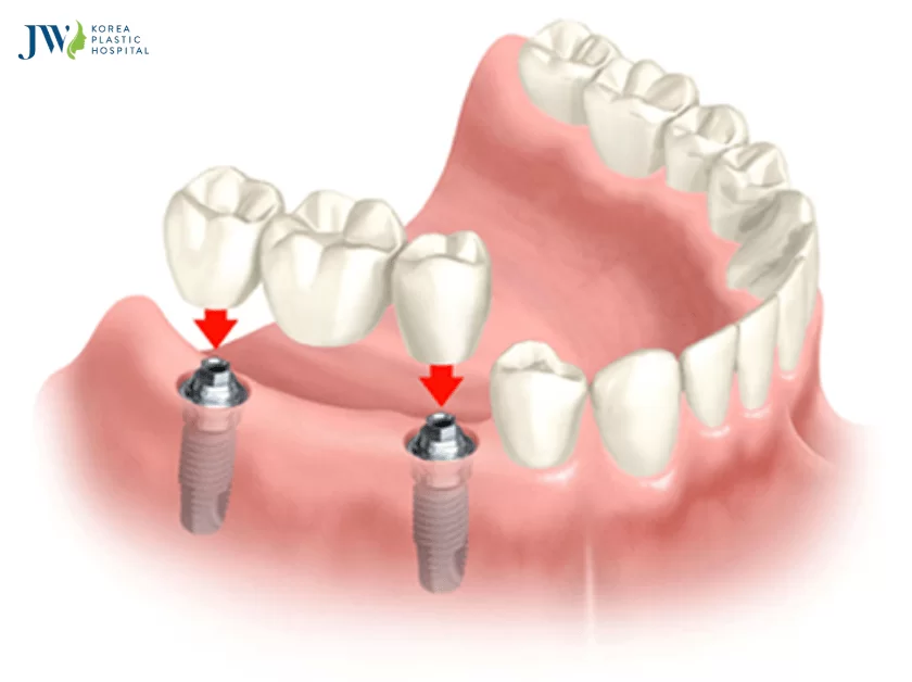 làm cầu răng sứ niềng răng