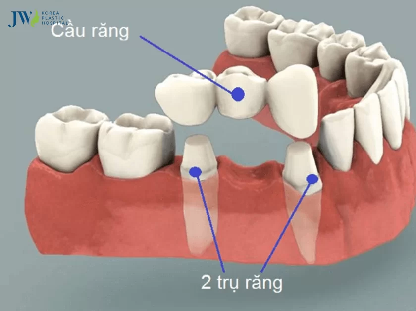 làm cầu răng sứ niềng răng