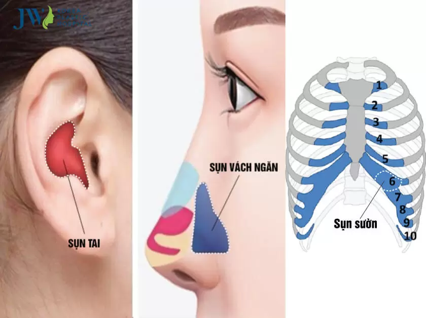 Nâng mũi sụn sườn - Tái sinh dáng mũi tự nhiên hoàn hảo nhất