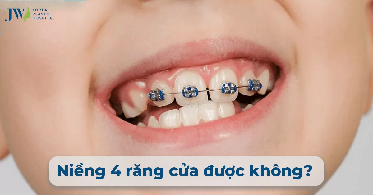 Niềng 4 Răng Cửa Được Không? Chi Phí Bao Nhiêu