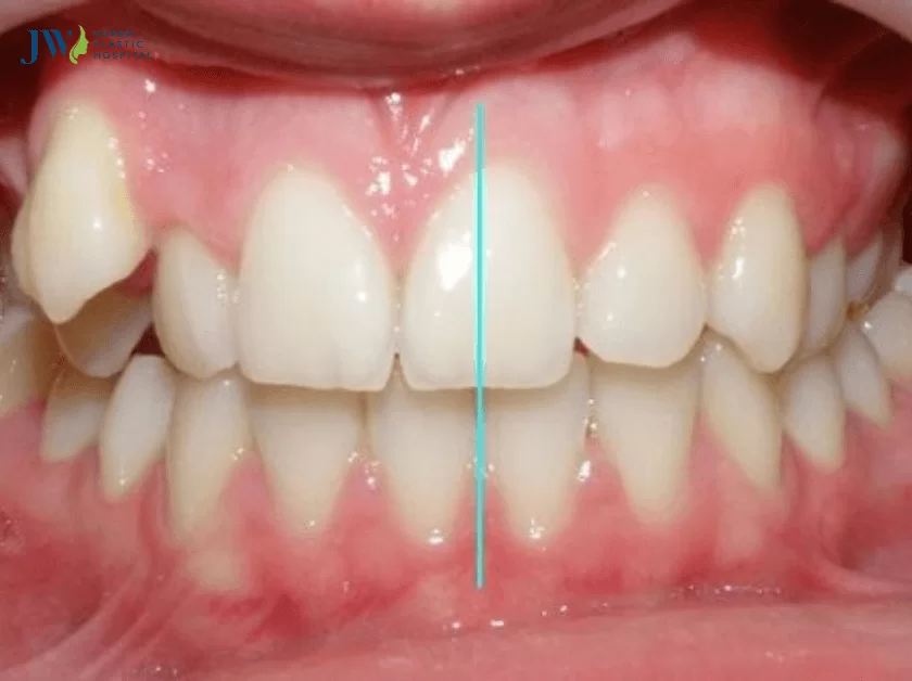 Niềng răng bị lệch mặt