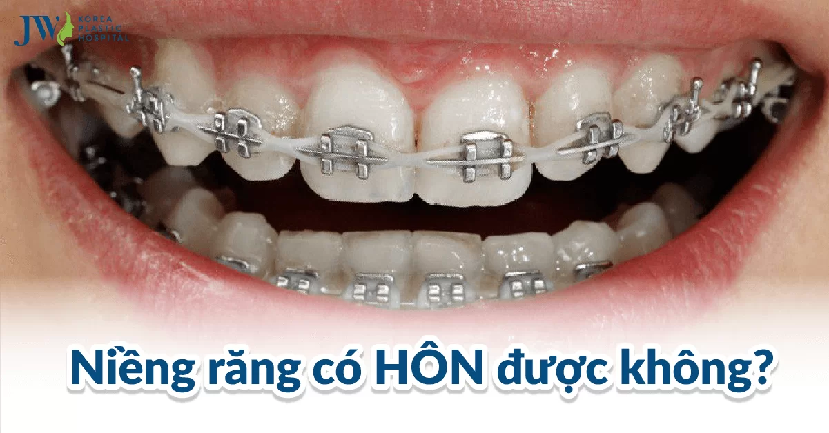 Niềng Răng Có Hôn Được Không? Những Mẹo Nhỏ Bạn Cần Biết