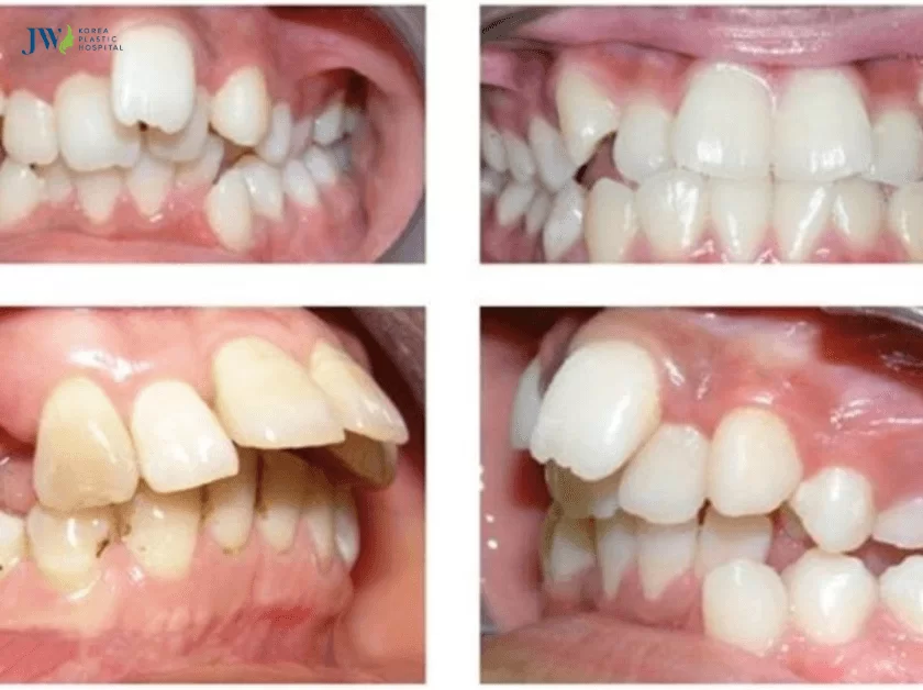 niềng răng có làm bớt cằm lẹm không
