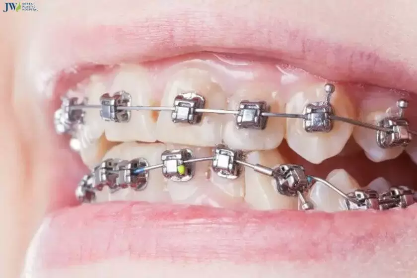 Niềng răng mắc cài tự buộc tiết kiệm thời gian thăm khám cùng bác sĩ 