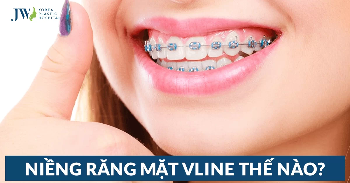 Niềng răng mặt VLine – Giúp răng đẹp và cằm thon gọn