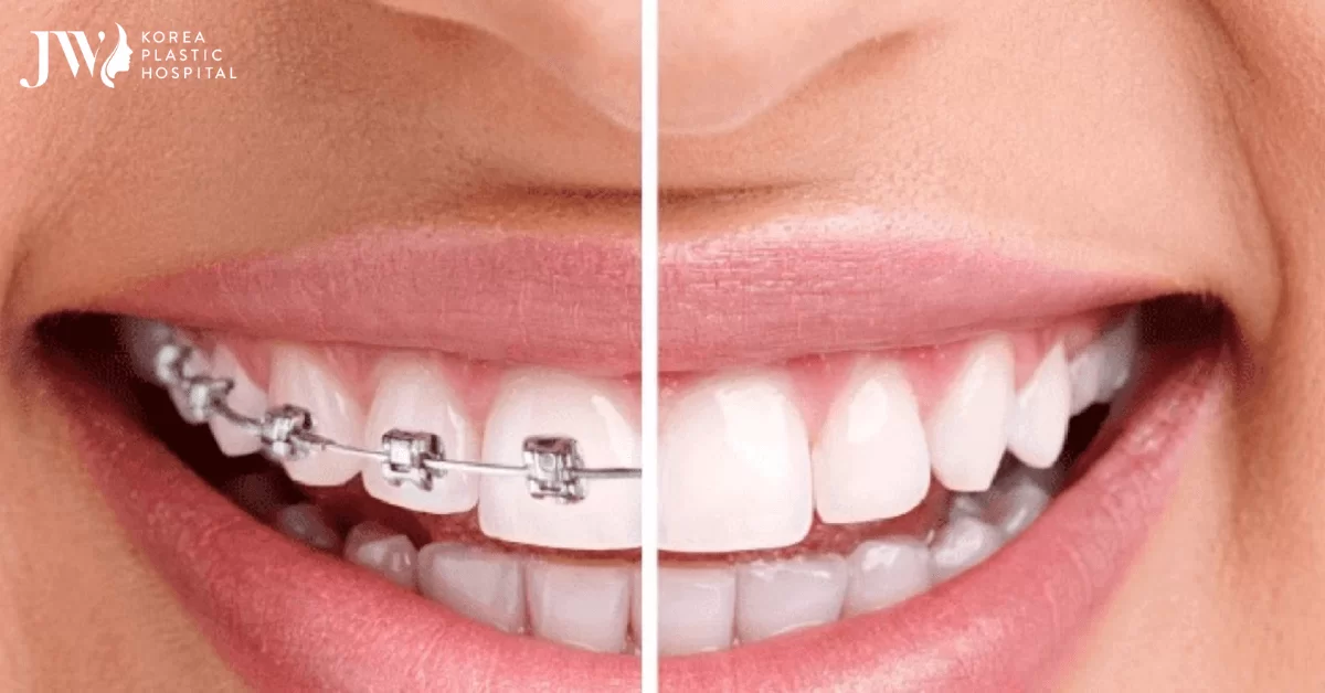 Niềng răng sau 6 tháng có thật sự hiểu quả?