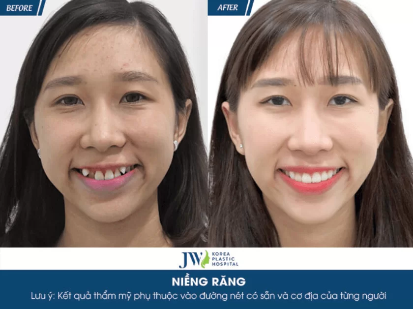 Niềng răng mặt Vline