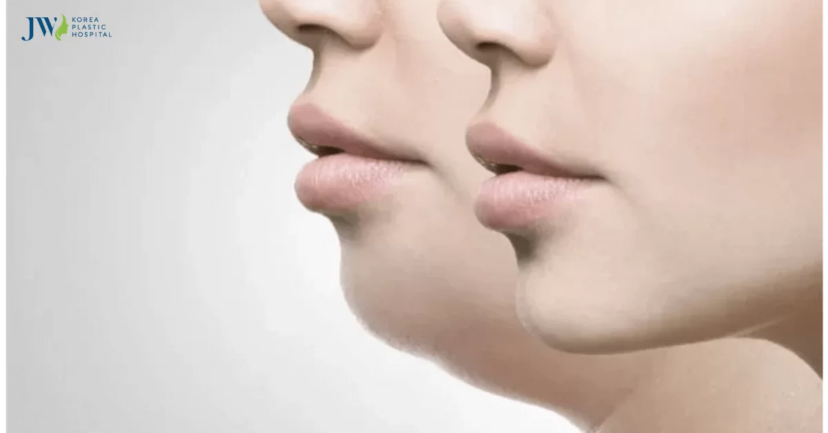 [ GÓC THẮC MẮC] Niềng răng thay đổi góc nghiêng có thật không?