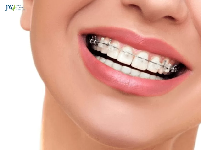 niềng răng xong vẫn hô