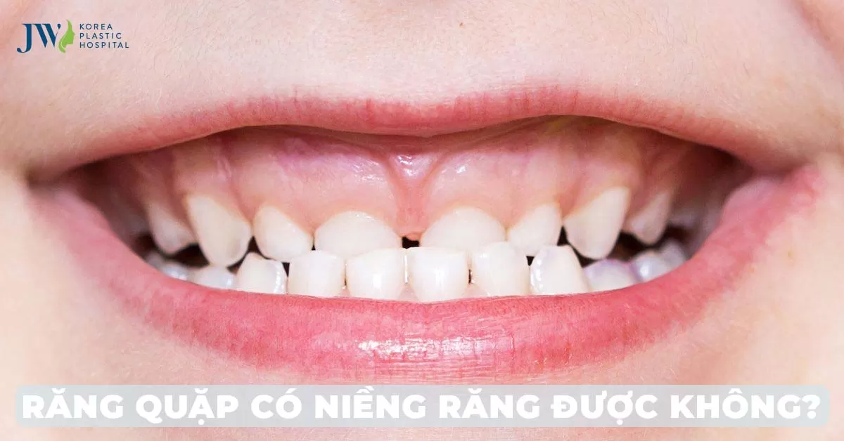 Răng quặp có niềng được không?