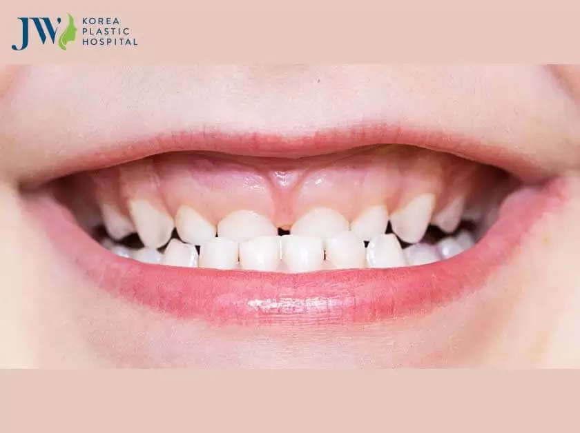 Răng quặp có niềng được không?