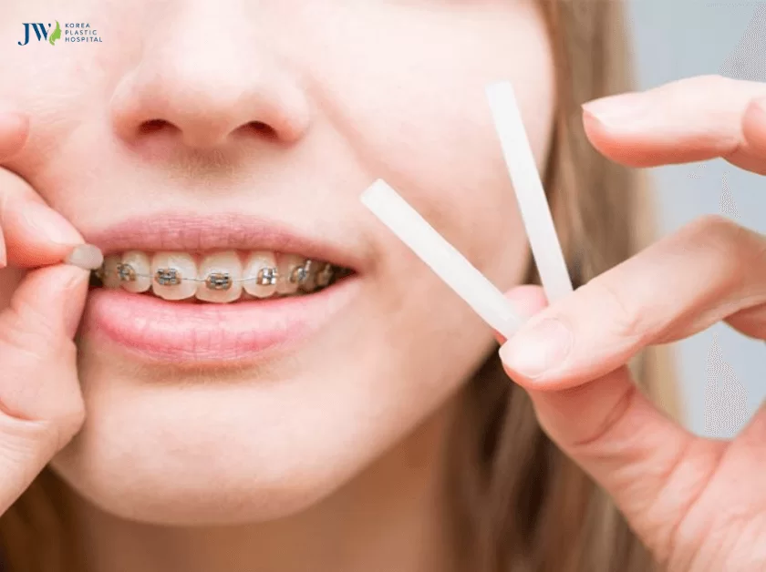 Niềng răng có hôn được không