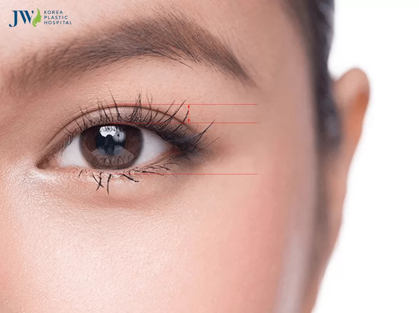 Tái phẫu thuật mắt 