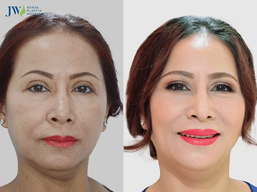 Tái phẫu thuật mắt