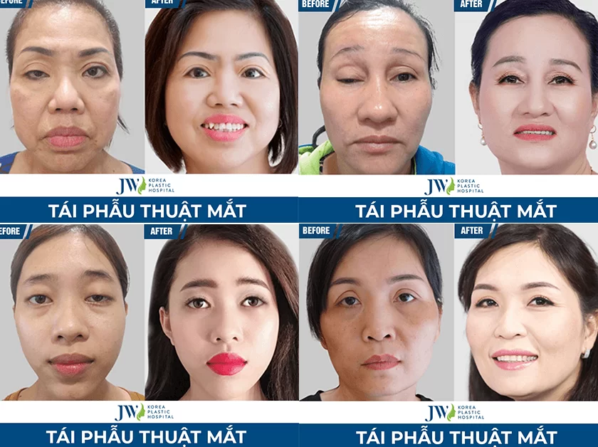 Tái phẫu thuật mắt