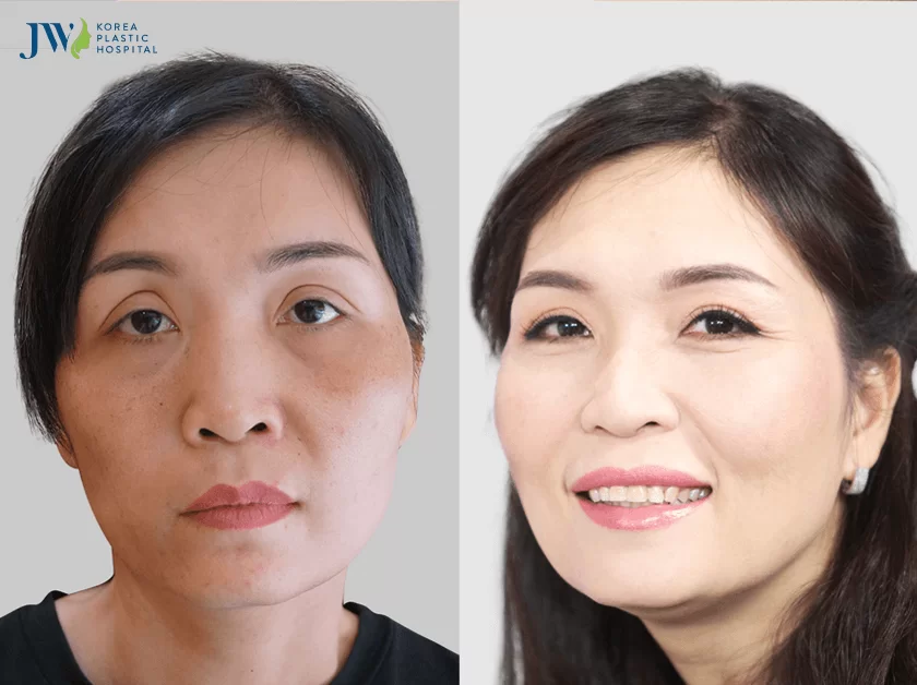 Tái phẫu thuật mắt