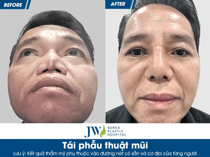 Tái phẫu thuật mũi - Giải pháp khắc phục mọi dáng mũi biến chứng