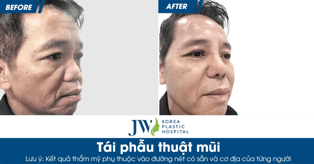 Tái phẫu thuật mũi – Giải pháp khắc phục mọi dáng mũi biến chứng