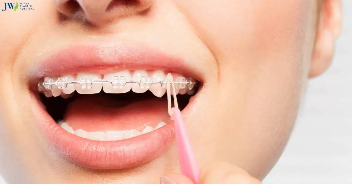 Thun liên hàm có tác dụng gì? Cách đeo thun như thế nào?