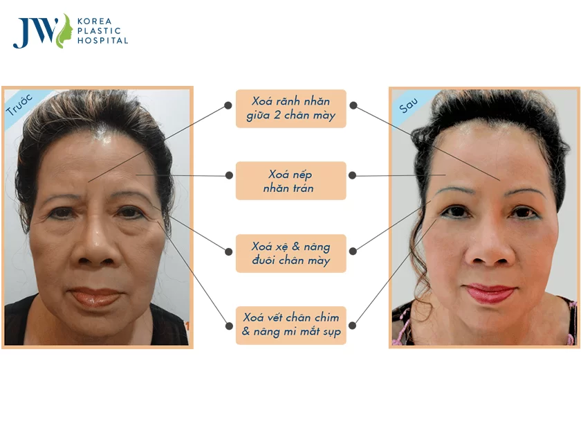 Treo chân mày nội soi 4X
